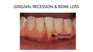 Bone Recession Impact of Stress and Bruxism on Dental Health: Causes, Effects, and ...