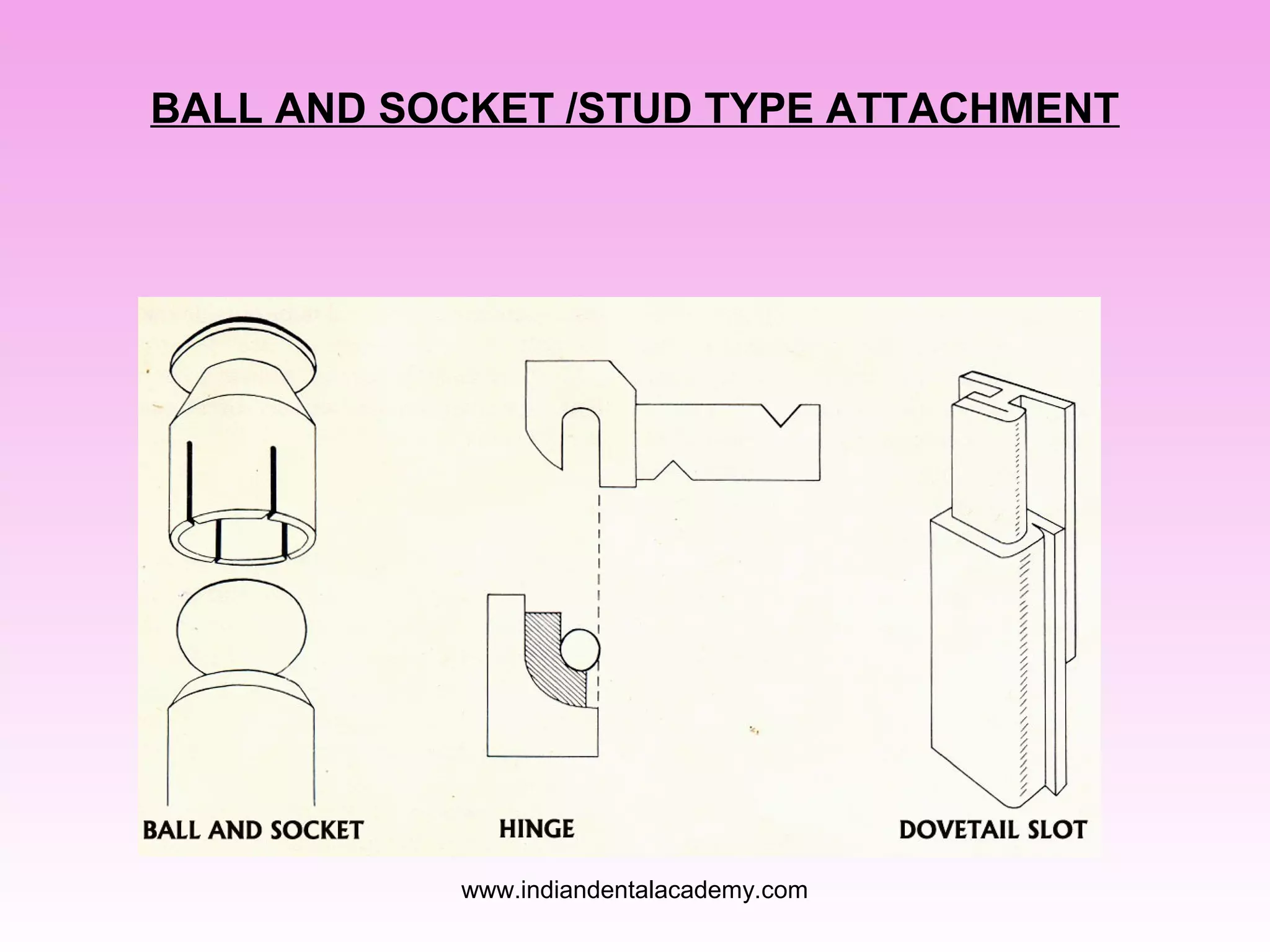 BALL AND SOCKET /STUD TYPE ATTACHMENT
www.indiandentalacademy.com
 