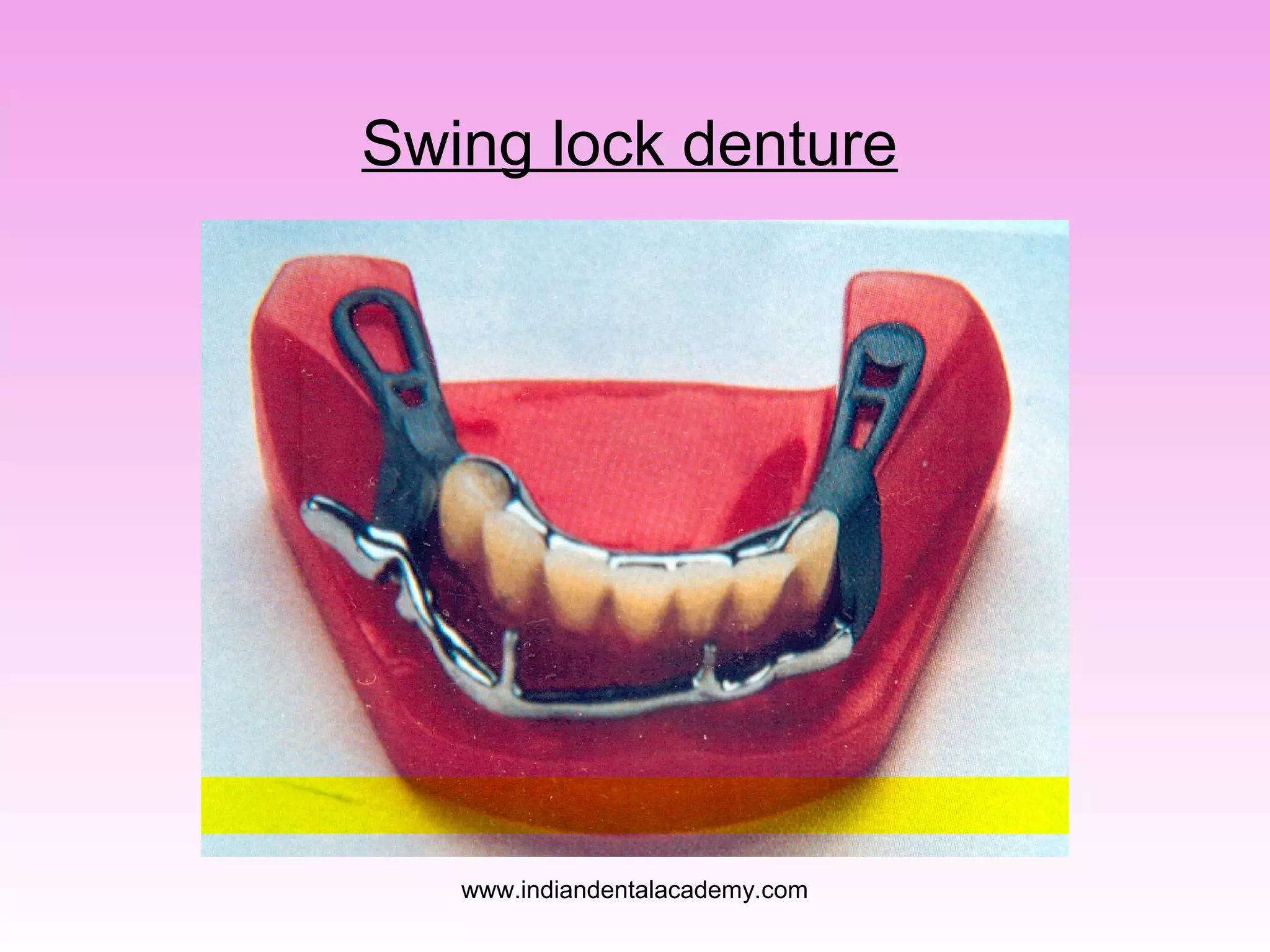 Swing lock denture
www.indiandentalacademy.com
 