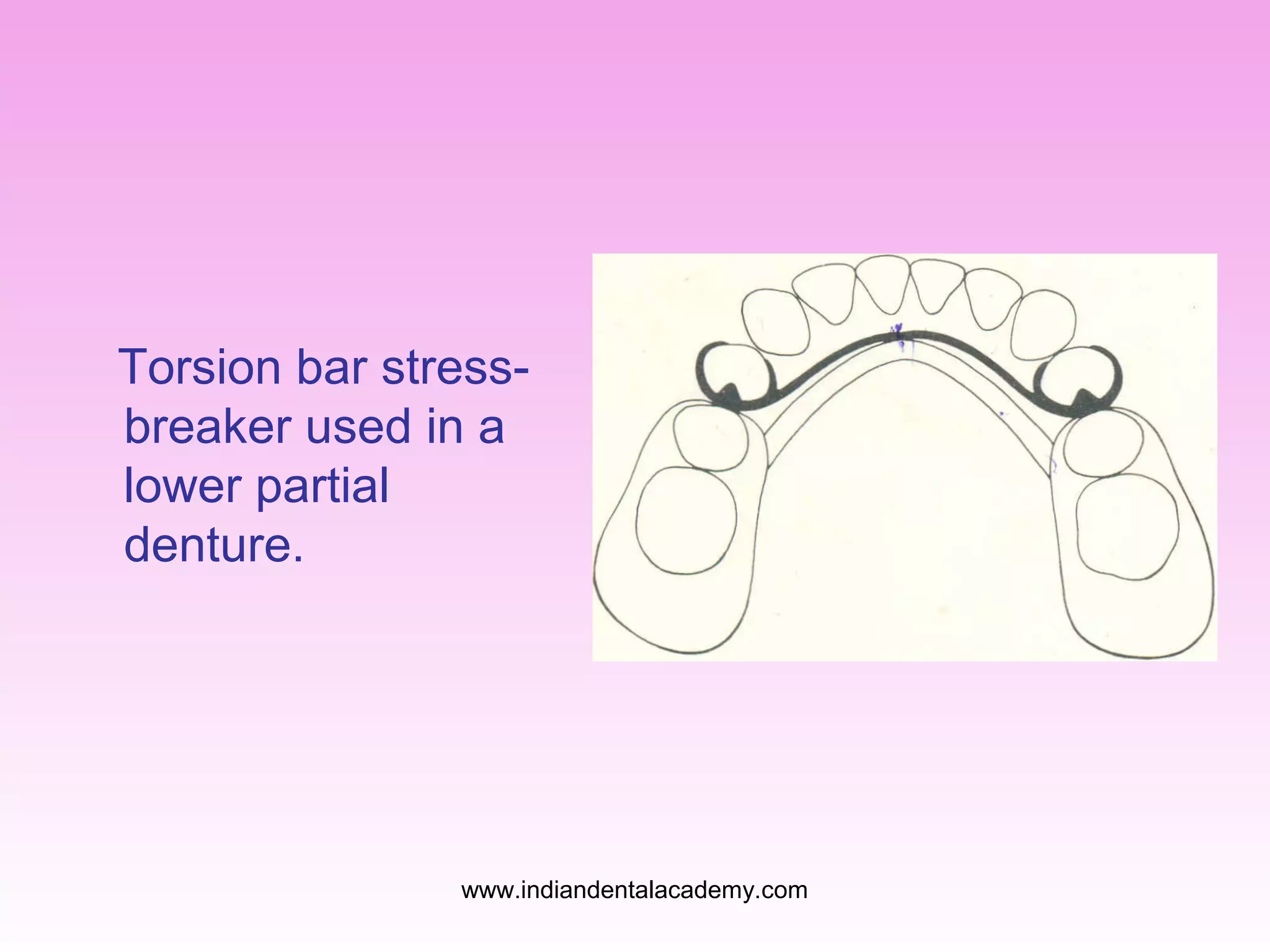 Torsion bar stressbreaker used in a
lower partial
denture.

www.indiandentalacademy.com

 