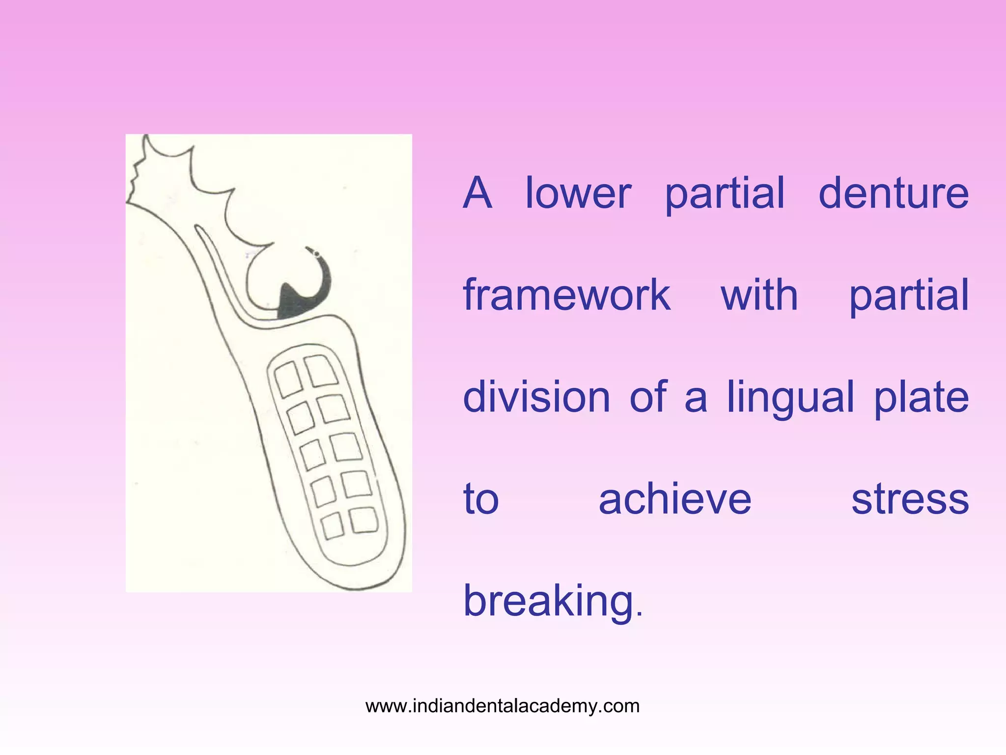 A lower partial denture
framework

with

partial

division of a lingual plate
to

achieve

breaking.
www.indiandentalacademy.com

stress

 
