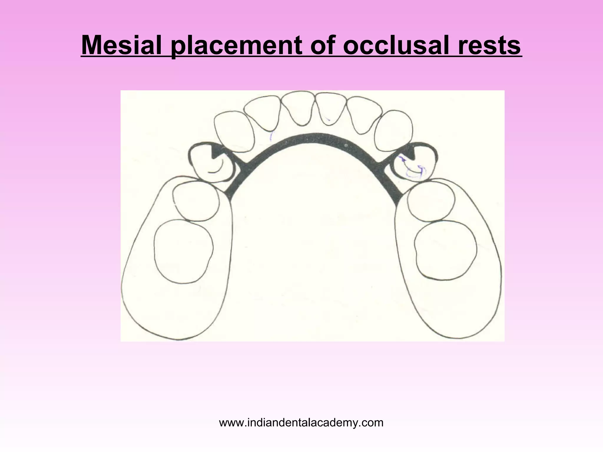 Mesial placement of occlusal rests

www.indiandentalacademy.com

 