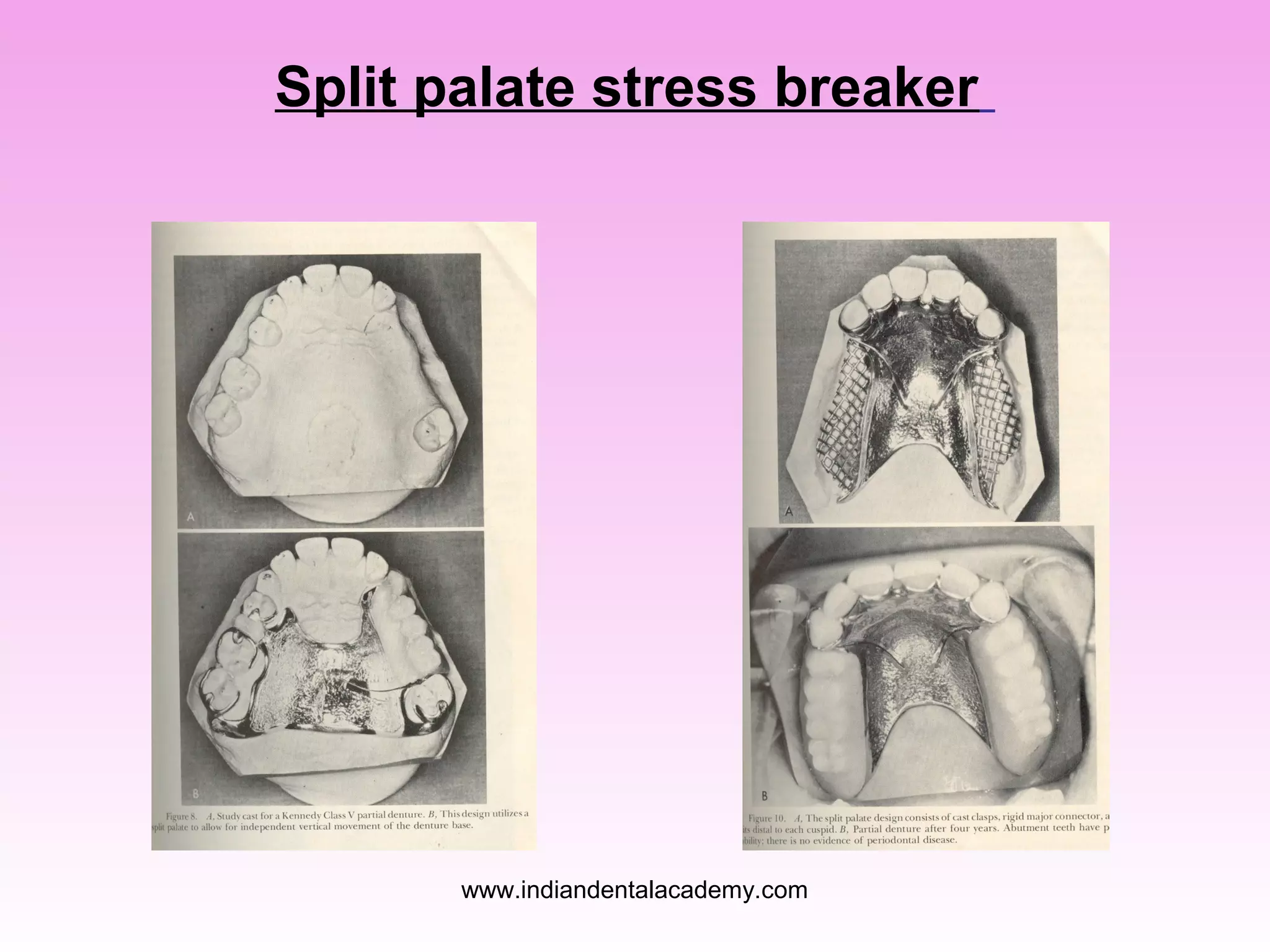 Split palate stress breaker

www.indiandentalacademy.com

 