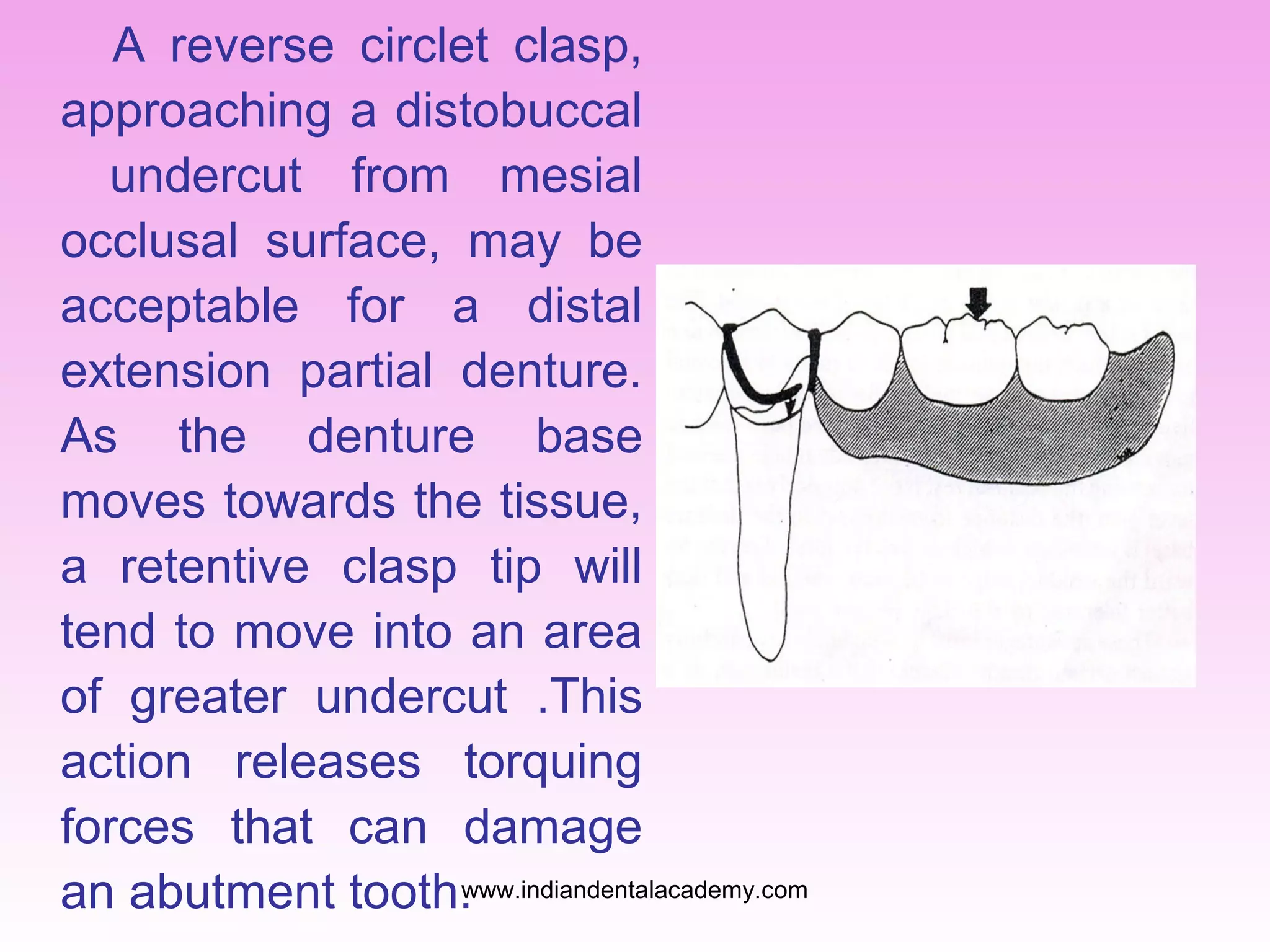 A reverse circlet clasp,
approaching a distobuccal
undercut from mesial
occlusal surface, may be
acceptable for a distal
extension partial denture.
As the denture base
moves towards the tissue,
a retentive clasp tip will
tend to move into an area
of greater undercut .This
action releases torquing
forces that can damage
www.indiandentalacademy.com
an abutment tooth.

 