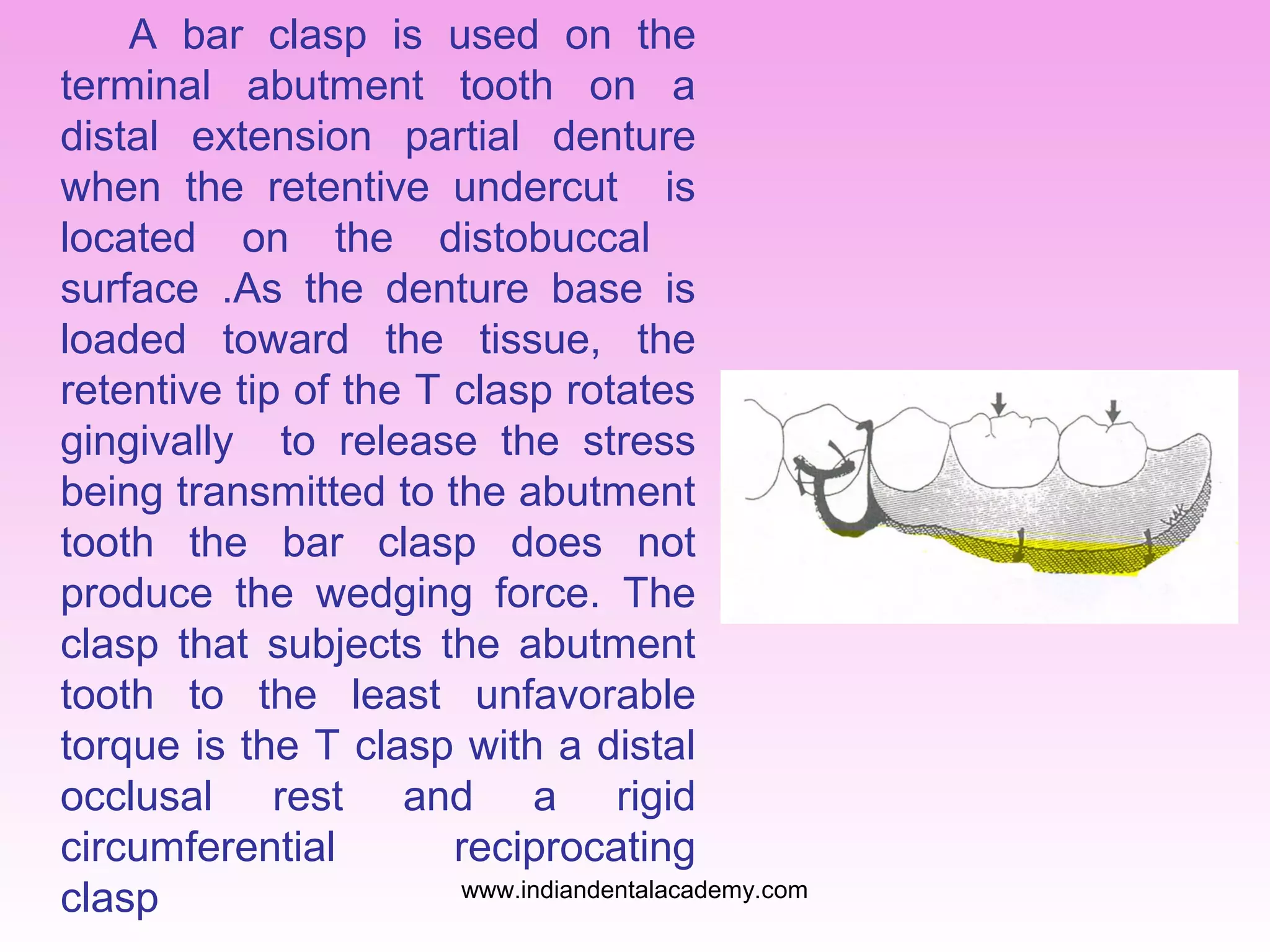 A bar clasp is used on the
terminal abutment tooth on a
distal extension partial denture
when the retentive undercut is
located on the distobuccal
surface .As the denture base is
loaded toward the tissue, the
retentive tip of the T clasp rotates
gingivally to release the stress
being transmitted to the abutment
tooth the bar clasp does not
produce the wedging force. The
clasp that subjects the abutment
tooth to the least unfavorable
torque is the T clasp with a distal
occlusal rest and a rigid
circumferential
reciprocating
www.indiandentalacademy.com
clasp

 