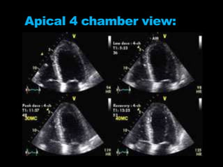 Apical 4 chamber view:
 