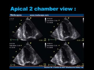 Apical 2 chamber view :
 