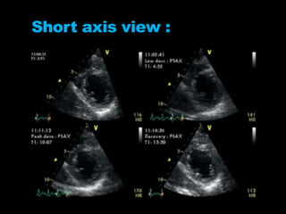 Short axis view :
 