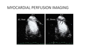 MYOCARDIAL PERFUSION IMAGING
 