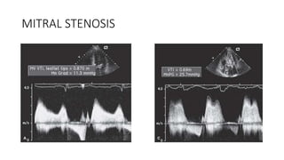 MITRAL STENOSIS
 