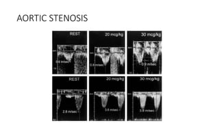AORTIC STENOSIS
 