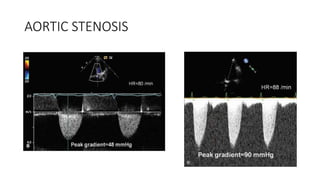 AORTIC STENOSIS
 