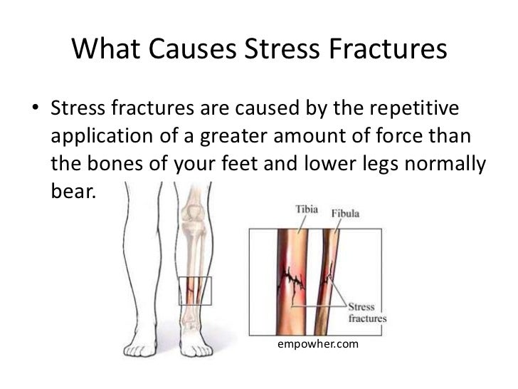 a lower leg stress fracture is Stress fractures aren't just a problem for active people, though they also affect people with weak bones or nutritional deficiencies, and can happen in the foot, leg, spine, arm, ribs, and other bony locations. a lower leg stress fracture is Stress fractures aren't just a problem for active people, though they also affect people with weak bones or nutritional deficiencies, and can happen in the foot, leg, spine, arm, ribs, and other bony locations.
