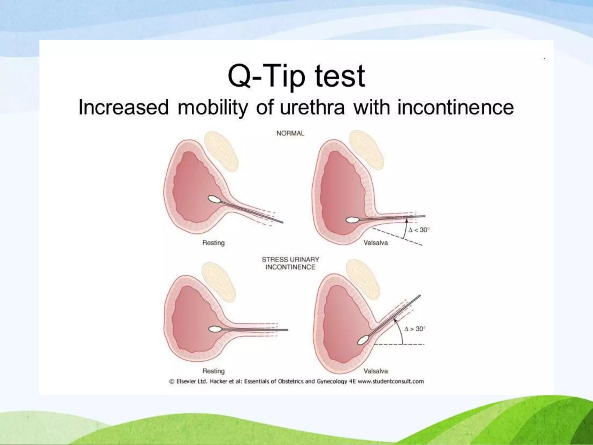 Urinary Stress Incontinence | PPTX