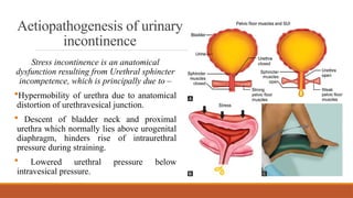Stress Incontinence MANAGEMENT IN PHYSIOTHERAPY | PPTX