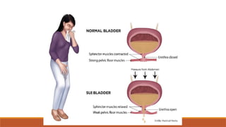 Stress Incontinence Animation Stress Incontinence MANAGEMENT IN PHYSIOTHERAPY | PPTX