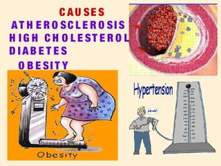 C AU SE S
AT H E R O SC L E R O SI S
H I G H C H O L E ST E R O L
D I AB E T E S
O B E SI T Y
 