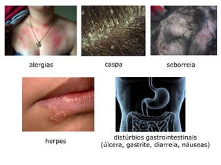 alergias       caspa                seborreia




                  distúrbios gastrointestinais
     herpes
              (úlcera, gastrite, diarreia, náuseas)
 