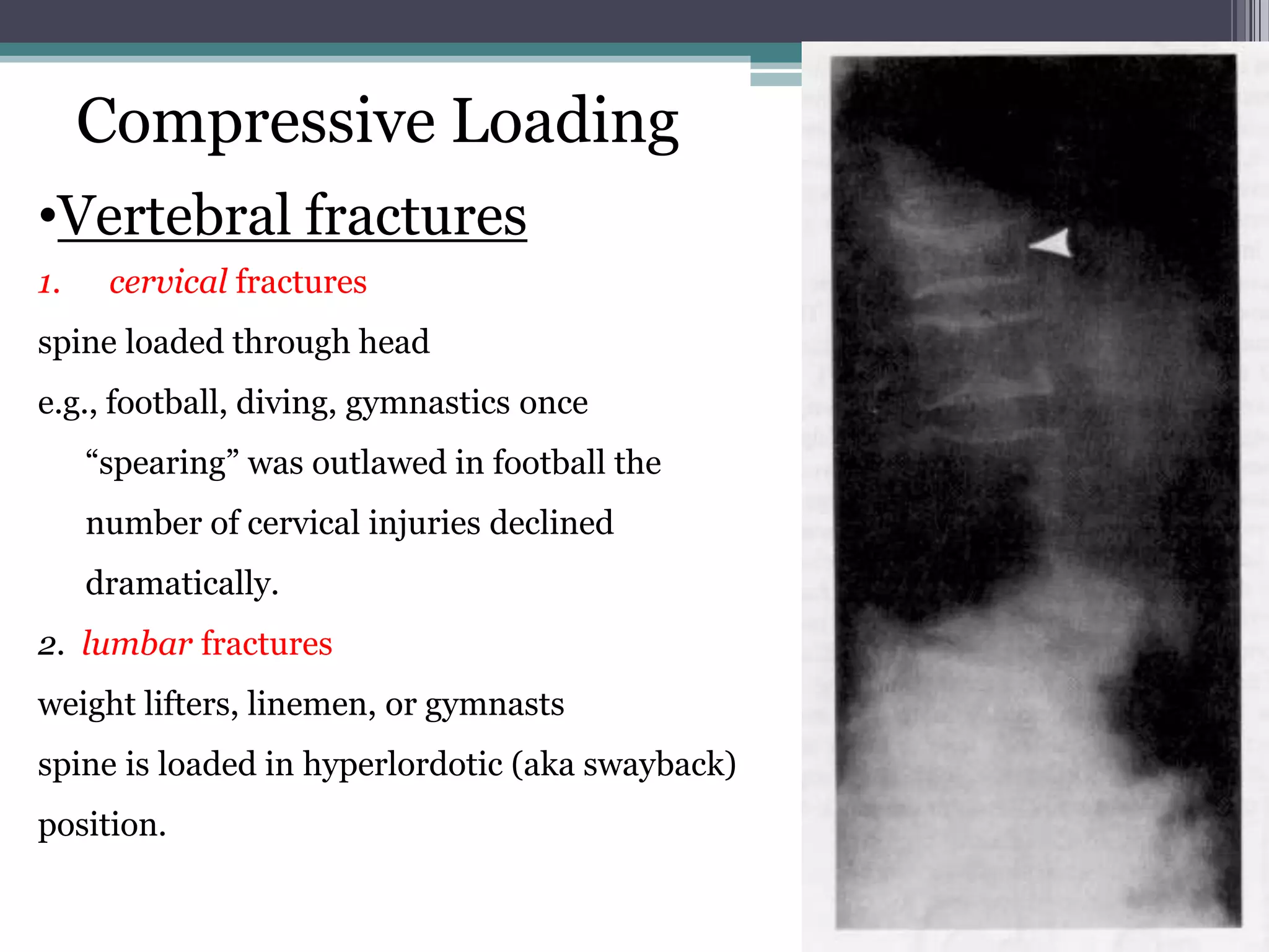 •Vertebral fractures
1. cervical fractures
spine loaded through head
e.g., football, diving, gymnastics once
“spearing” was outlawed in football the
number of cervical injuries declined
dramatically.
2. lumbar fractures
weight lifters, linemen, or gymnasts
spine is loaded in hyperlordotic (aka swayback)
position.
Compressive Loading
 