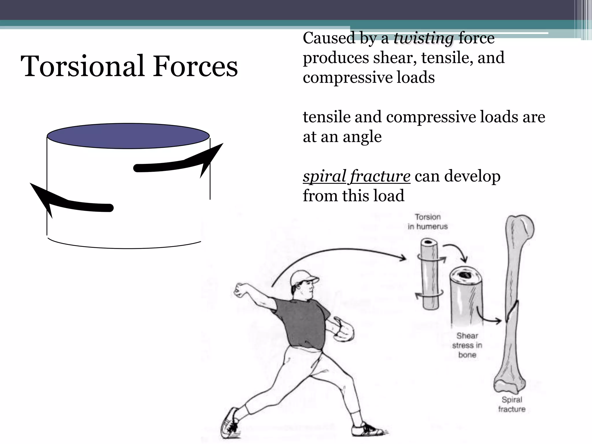 Torsional Forces
Caused by a twisting force
produces shear, tensile, and
compressive loads
tensile and compressive loads are
at an angle
spiral fracture can develop
from this load
 
