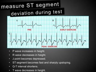 Interpretation of Stress test