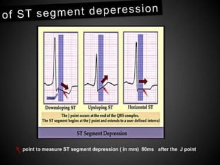 Interpretation of Stress test