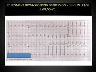 Interpretation of Stress test