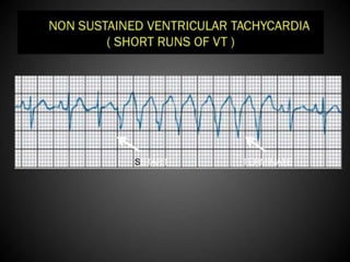Interpretation of Stress test