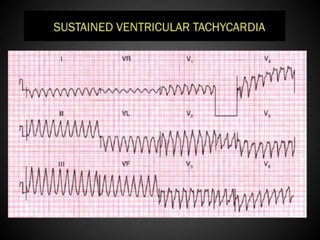 Interpretation of Stress test