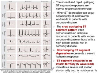 37
 The normal and rapid upsloping
ST segment responses are
normal responses to exercise.
 Minor ST depression can occur
occasionally at submaximal
workloads in patients with
coronary disease.
 The slow upsloping ST
segment pattern often
demonstrates an ischemic
response in patients with known
coronary disease or those with a
high pretest clinical risk of
coronary disease.
 Downsloping ST segment
depression represents a severe
ischemic response.
 ST segment elevation in an
infarct territory (Q wave lead)
indicates a severe wall motion
abnormality and, in most cases, is
 