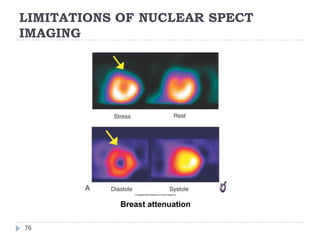 LIMITATIONS OF NUCLEAR SPECT
IMAGING
76
Breast attenuation
 