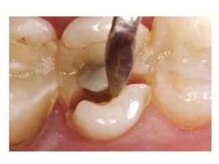 • Division C (compromised bone)
 0–2.5 mm in width (C-w bone)
 Less than 12 mm in height (C-h bone)
 More than 30° in a...