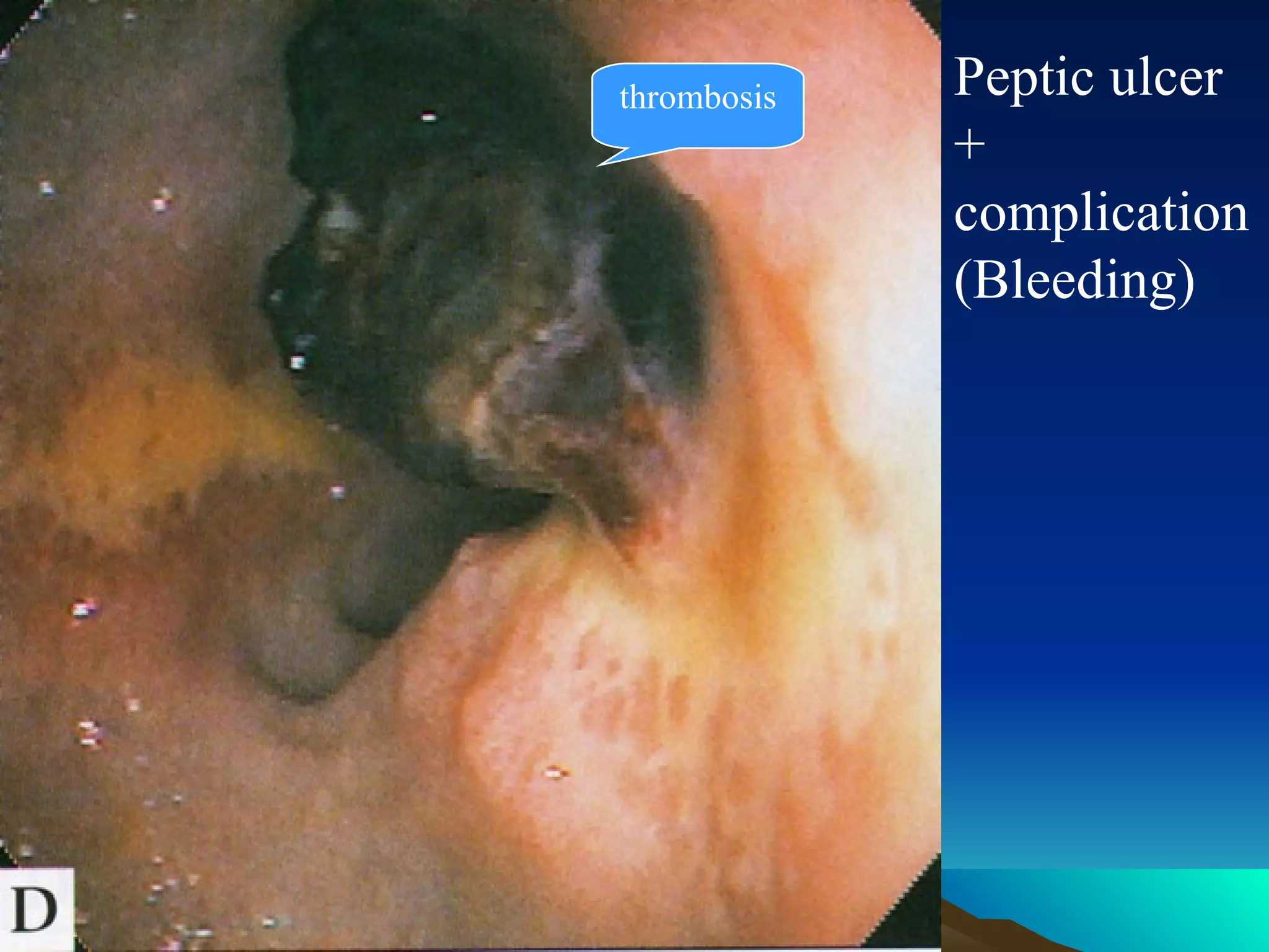 thrombosis Peptic ulcer + complication (Bleeding) 