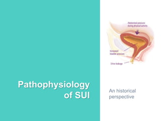 Stress urinary incontinence | PDF