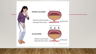 Comprehensive Overview of Stress Urinary Incontinence: Diagnosis and ...