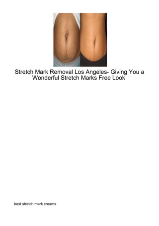 Stretch Mark Removal Los Angeles- Giving You a
       Wonderful Stretch Marks Free Look




best stretch mark creams
 