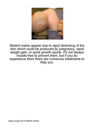 Stretch marks appear due to rapid stretching of the
 skin which could be produced by pregnancy, rapid
 weight gain, or quick growth spurts. It's not always
      trouble free to prevent them, but if you do
 experience them there are numerous treatments to
                       help you.




ways to get rid of stretch marks
 