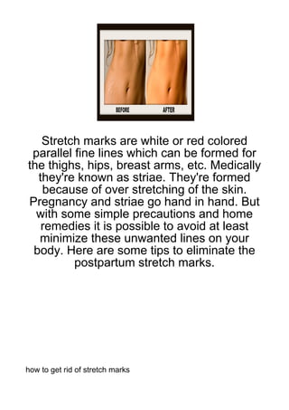 Stretch marks are white or red colored
 parallel fine lines which can be formed for
the thighs, hips, breast arms, etc. Medically
  they're known as striae. They're formed
   because of over stretching of the skin.
Pregnancy and striae go hand in hand. But
  with some simple precautions and home
   remedies it is possible to avoid at least
  minimize these unwanted lines on your
 body. Here are some tips to eliminate the
          postpartum stretch marks.




how to get rid of stretch marks
 