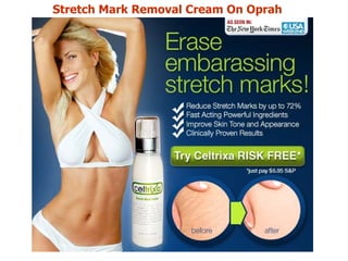 Stretch Mark Removal Cream On Oprah   