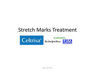 Stretch Marks Treatment




         www.celtrixa.tv
 