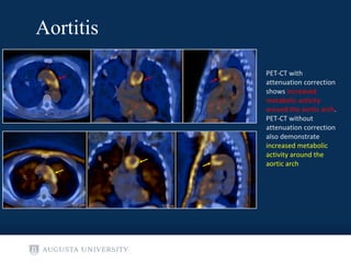 Non-malignant cardiac findings on FDG PET CT | PPT