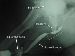 Stricture urethra by Dr.K.AmrithaAnilkumar | PPT