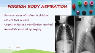 FOREIGN BODY ASPIRATION
• Potential cause of stridor in children
• MC are food & coins
• Urgent endoscopic visualization required
• Immediate removal by surgery
Lakshmi25
 