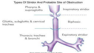 Stridor Pattern Stridor | PDF