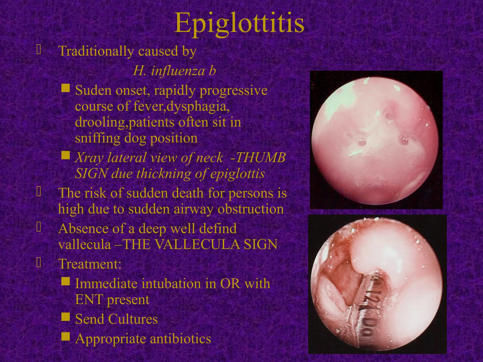  Traditionally caused by
H. influenza b
 Suden onset, rapidly progressive
course of fever,dysphagia,
drooling,patients often sit in
sniffing dog position
 Xray lateral view of neck -THUMB
SIGN due thickning of epiglottis
 The risk of sudden death for persons is
high due to sudden airway obstruction
 Absence of a deep well defind
vallecula –THE VALLECULA SIGN
 Treatment:
 Immediate intubation in OR with
ENT present
 Send Cultures
 Appropriate antibiotics
Epiglottitis
 