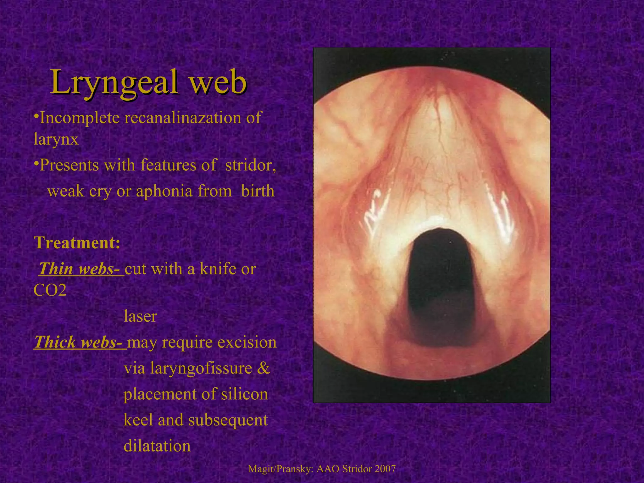 Lryngeal webLryngeal web
•Incomplete recanalinazation of
larynx
•Presents with features of stridor,
weak cry or aphonia from birth
Treatment:
Thin webs- cut with a knife or
CO2
laser
Thick webs- may require excision
via laryngofissure &
placement of silicon
keel and subsequent
dilatation
Magit/Pransky: AAO Stridor 2007
 
