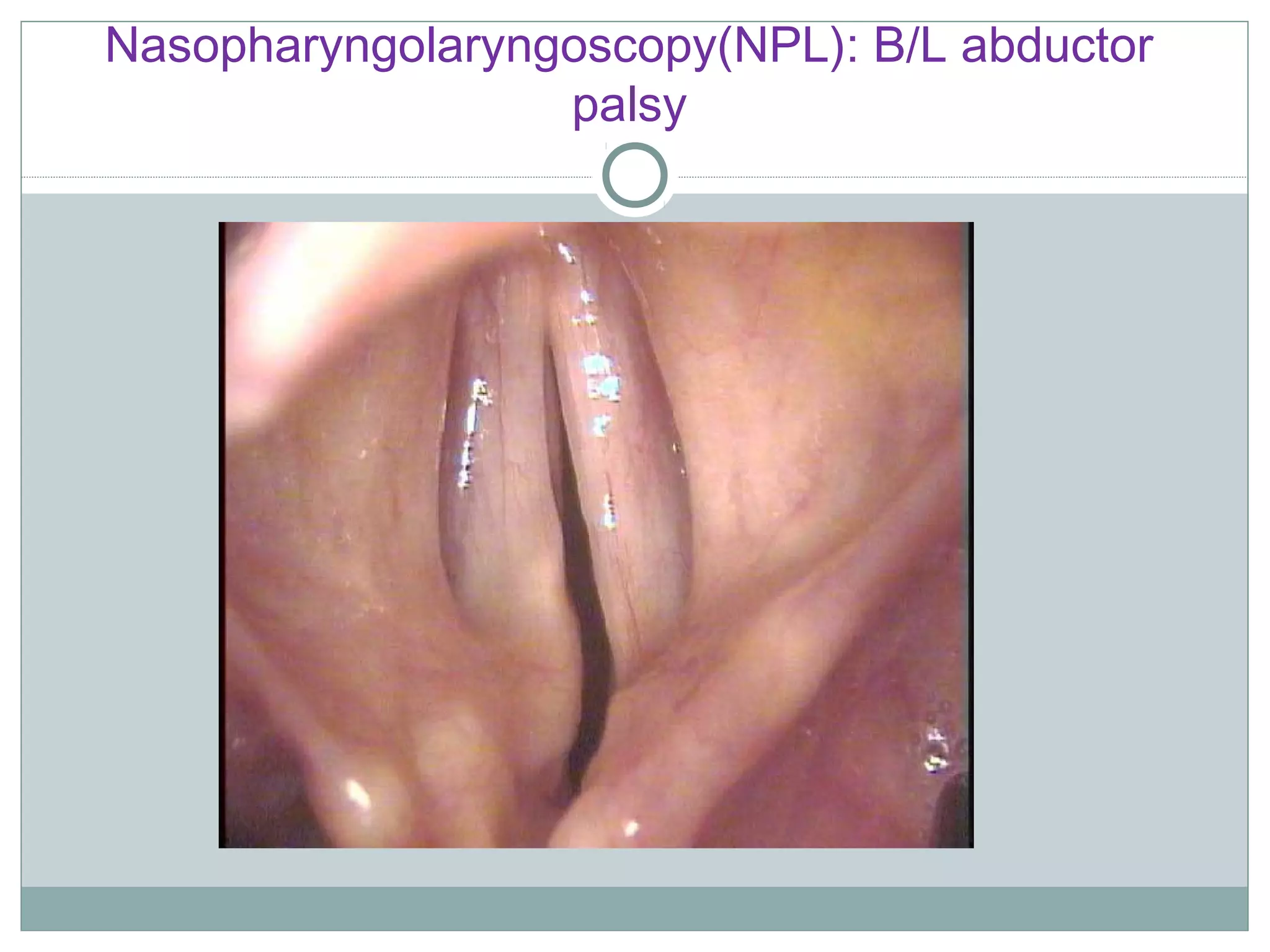Nasopharyngolaryngoscopy(NPL): B/L abductor
palsy
 