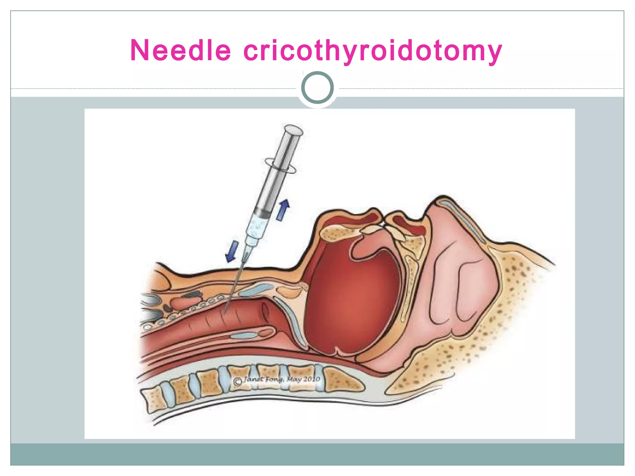 Needle cricothyroidotomy
 