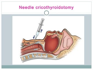Stridor and management of obstructed airway | PPT