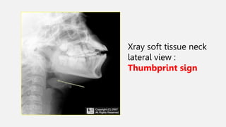 Xray soft tissue neck
lateral view :
Thumbprint sign
 